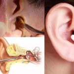 Home Remedies Ears