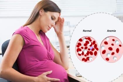 Iron Deficiency Anemia