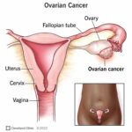 Clear Cell Ovarian Cancer