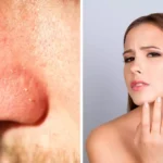 Blackheads And Unwanted Hair