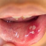 Mouth Blister Treatment