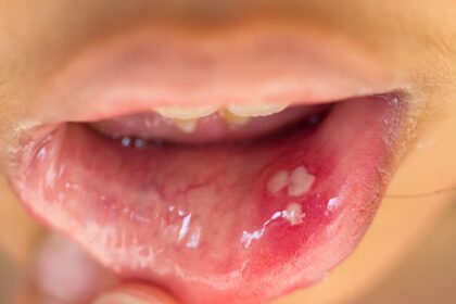 Mouth Blister Treatment