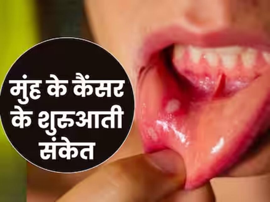 Early Sign of Mouth Cancer