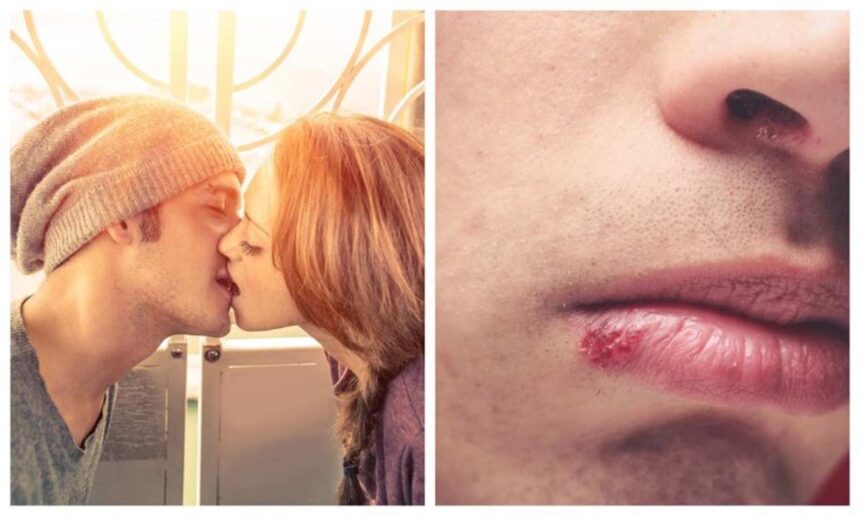 Kissing Disease