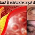 Bad Cholesterol Symptoms