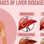 Liver Damage Symptoms