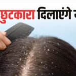 Dandruff Home Remedies