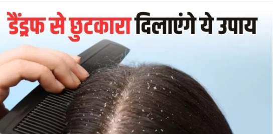 Dandruff Home Remedies